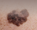 Melanoma no pé, é possível?