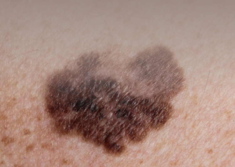 Melanoma no pé, é possível?